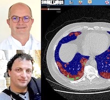 L’équipe du Pr Jacquier (La Timone), en collaboration avec Badih Ghattas (I2M), développe l’interface Smart Lungs